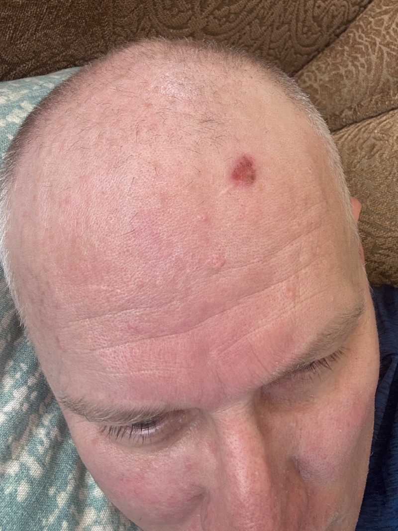 2025/08(August)/Travis-Dermatology-Mole-Freeze/800x600_2025-07-27-Travis-Mole-freeze-6.JPG