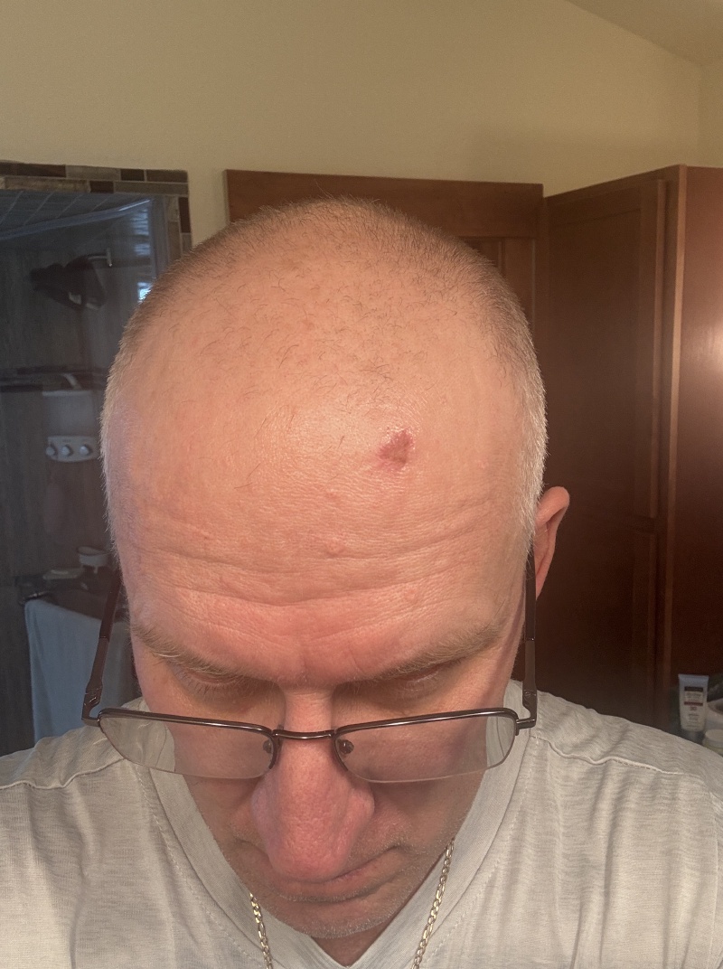 2025/08(August)/Travis-Dermatology-Mole-Freeze/800x600_2025-07-28-Travis-Mole-freeze-7.JPG